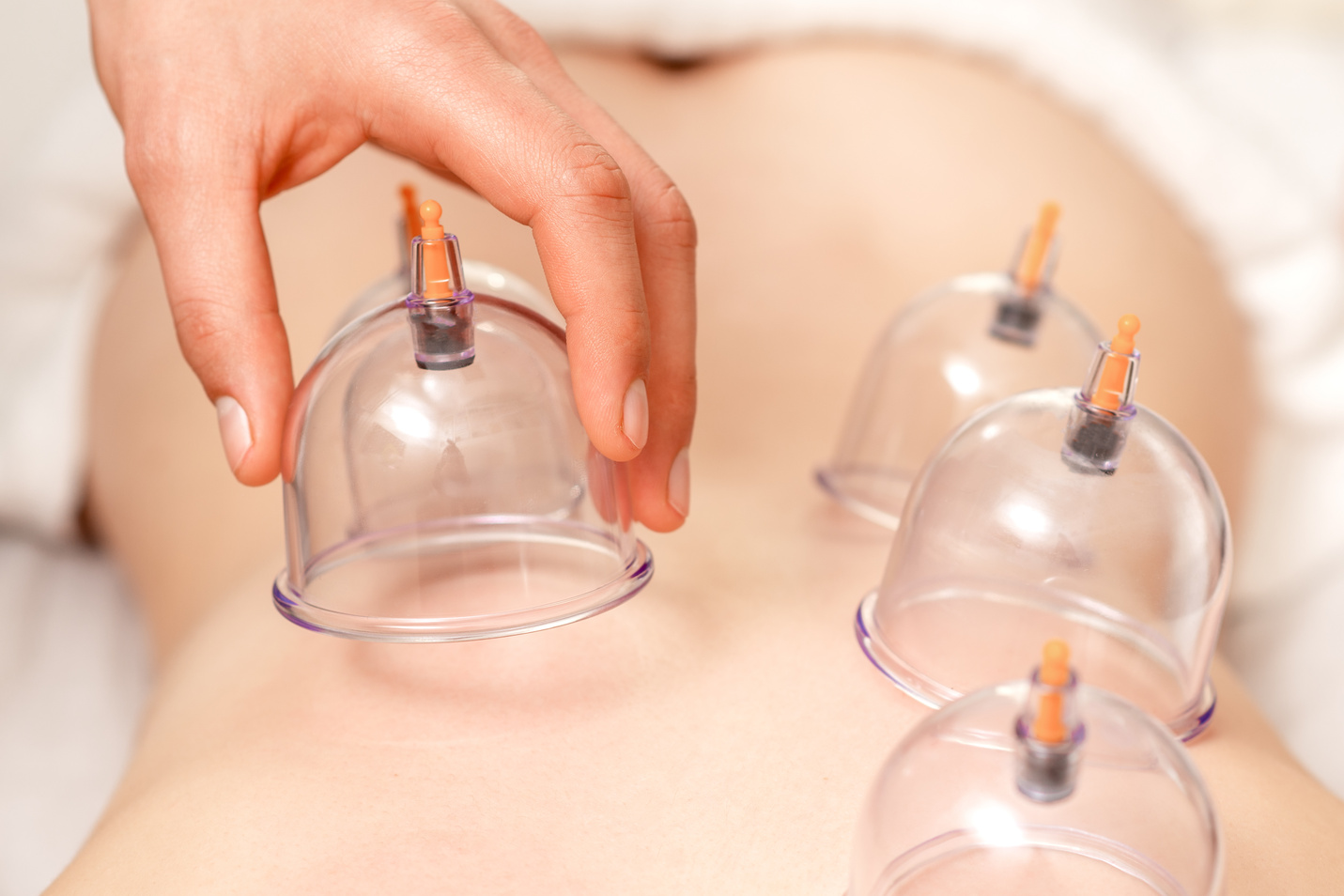 Vacuum cups of medical cupping therapy on woman back.